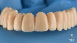 Detalle de la prótesis provisional fija utilizada durante la fase de osteointegración.