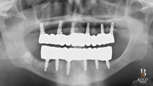 Radiografía final de control verificando el ajuste de las prótesis definitivas y la salud de los implantes.