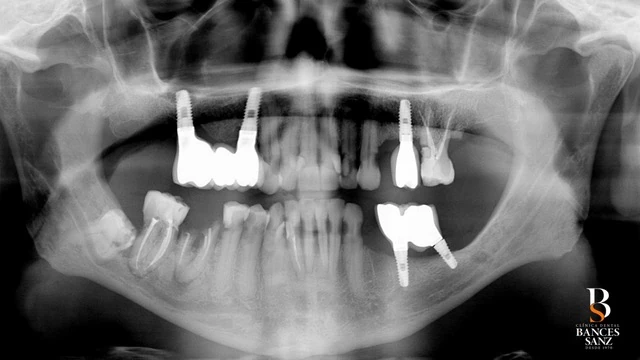 Radiografía panorámica inicial mostrando implantes antiguos no viables y pérdida ósea generalizada.