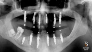 Radiografía postoperatoria tras cirugía guiada con técnica All-on-6 bimaxilar.
