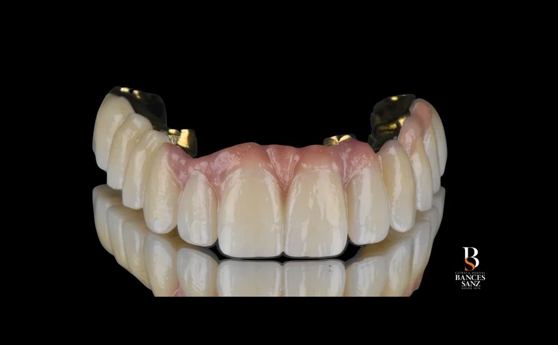 Prótesis dental híbrida final de alta estética para rehabilitación oral completa sobre implantes.