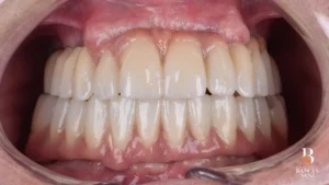Sonrisa definitiva del paciente tras la colocación de la rehabilitación fija de circonio sobre implantes.