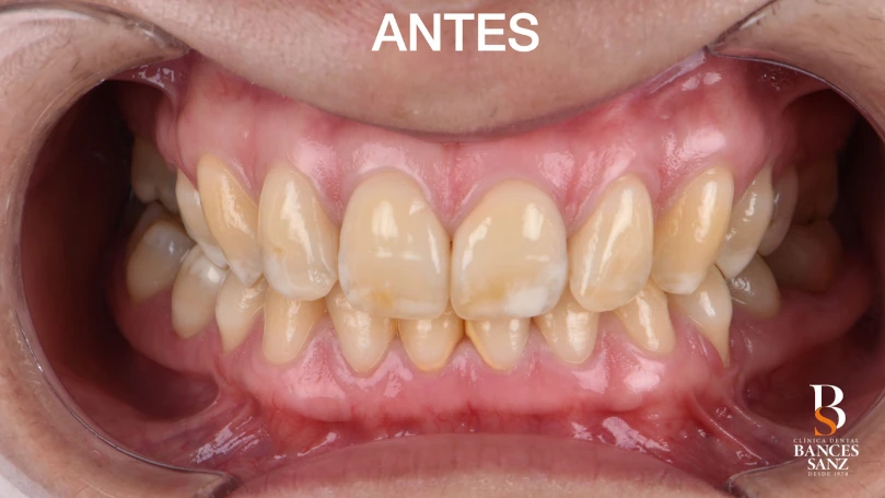 blanqueamiento post ortodoncia - antes