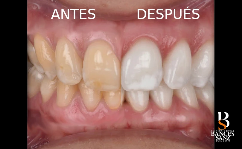 blanqueamiento post ortodoncia